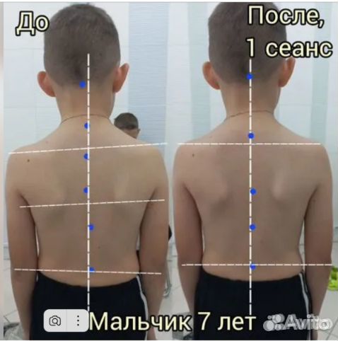 Остеопатическая коррекция, остеобаланс