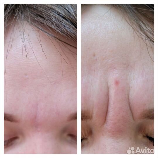 Релатокс, Ботокс