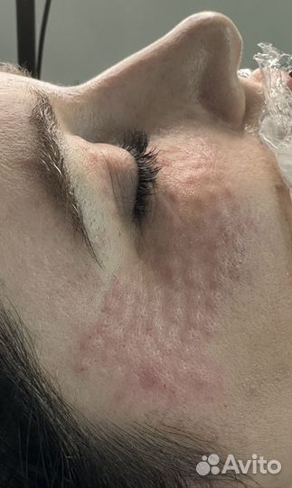 Биоревитализация/ Мезотерапия