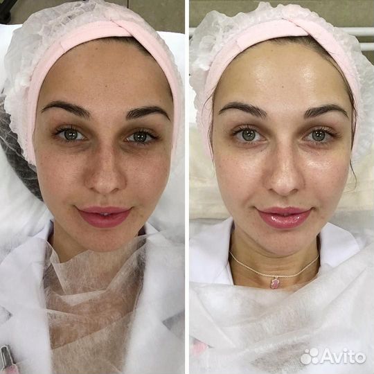 Фонофорез