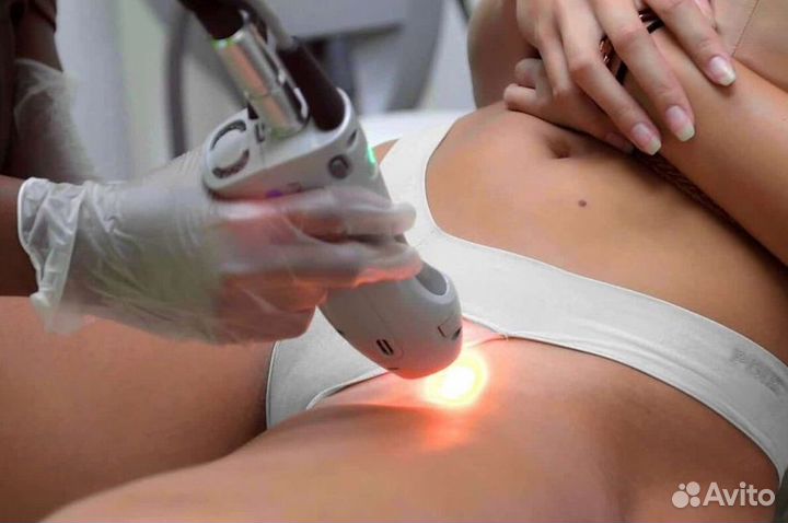 Бизнес лазерной эпиляции с клиентской базой