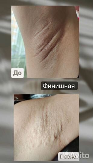 Электроэпиляция модель