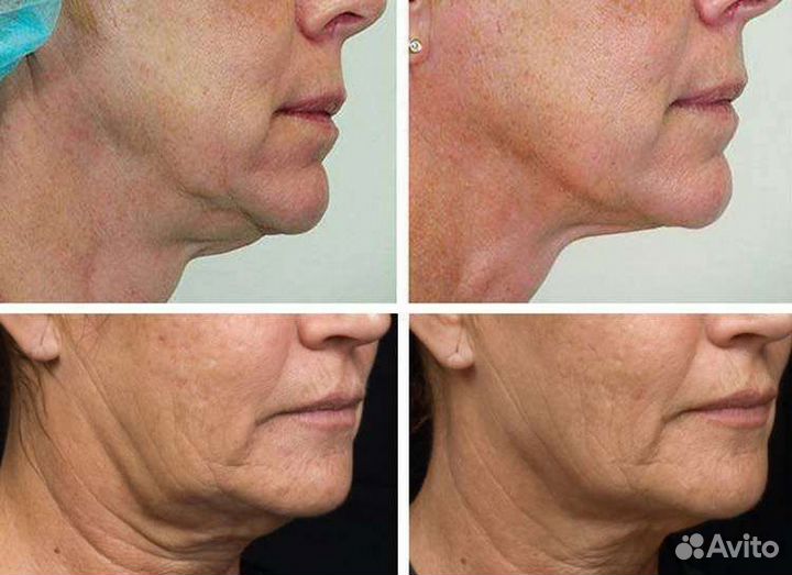 RF-лифтинг для лица