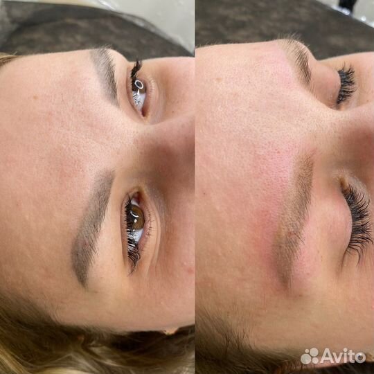 Лазерное удаление тату татуажа