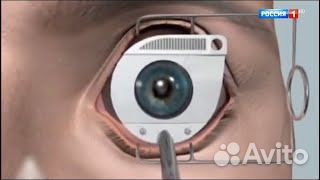 Офтальмолог,зелён. лазер,YAG,рефракционная хирурги