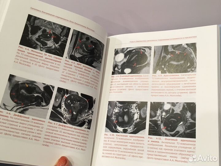 Аденомиоз. Контроль версий современности. Цхай