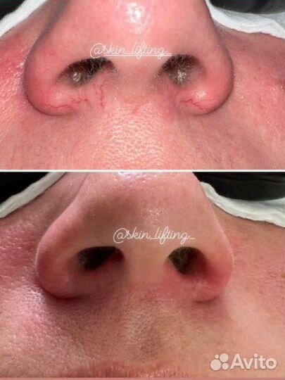 Сосуды/Купероз/Лицо/Тело