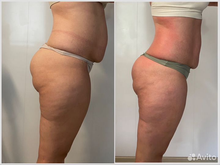 Антицеллюлитный массаж