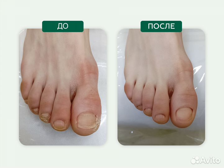 Медицинский, подологический педикюр, подолог