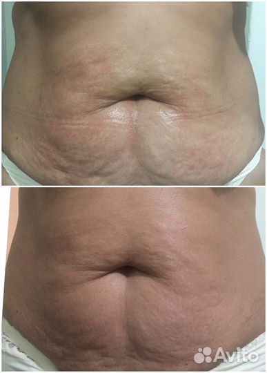 Exilis Ultra 360 RF лифтинг тела похудение