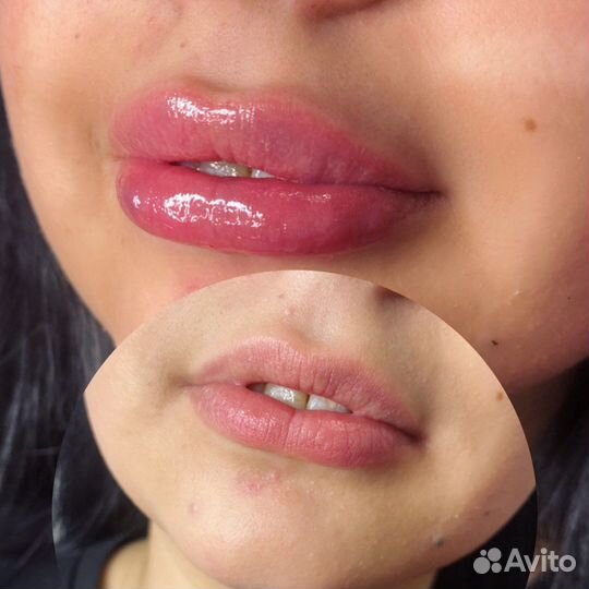 Увеличение губ,Косметолог,Биоревитализация