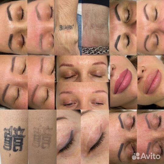 Модели на удаление татуажа лазером