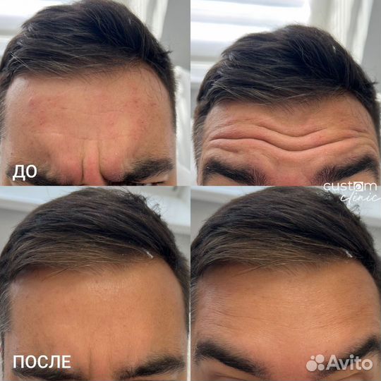 Ботулинотерапия, ботокс лица