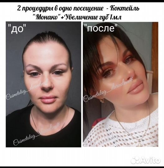 Уколы красоты Full Face(Лицо под ключ )