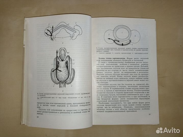 Рак гортаноглотки и шейного отдела пищевода. Гамбу
