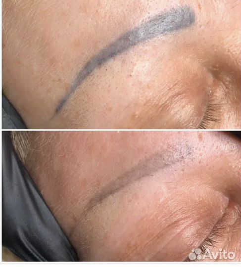 Удаление татуажа и тату