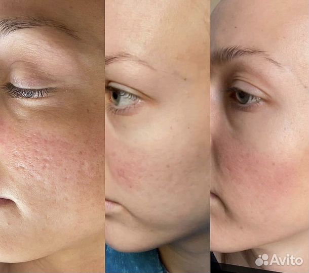 Микроигольчатый RF лифтинг лица