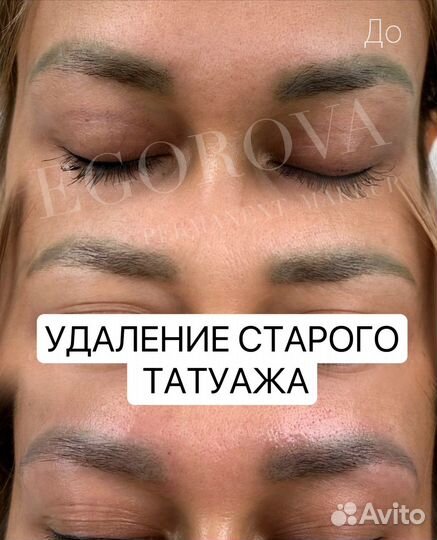 Удаление татуажа ремувером