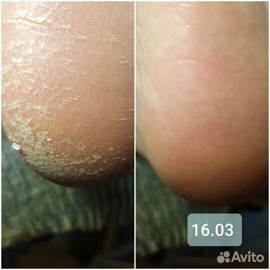 Подология, smart педикюр, моделирование