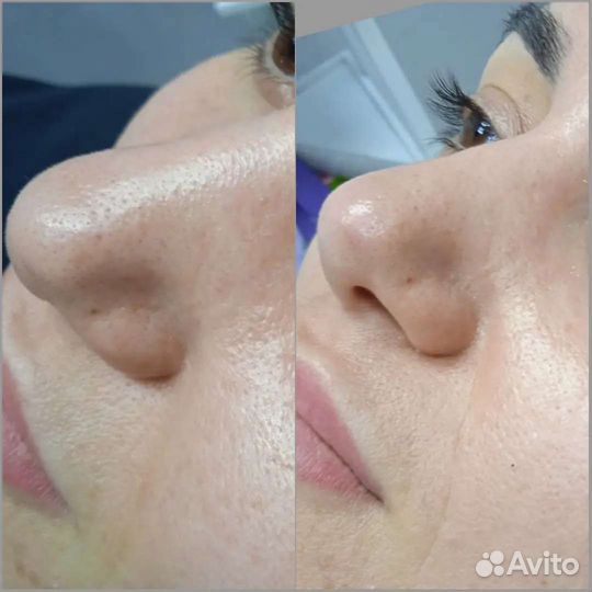 Механическая чистка лица