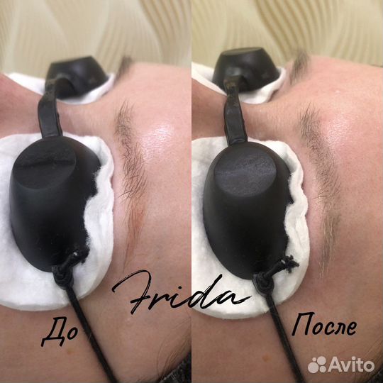 Лазерное удаление татуажа и татуировок