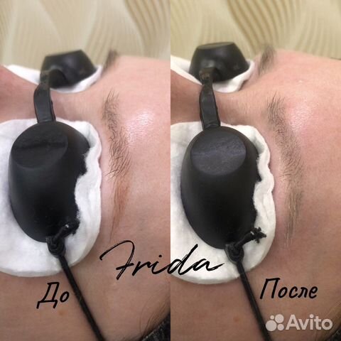 Лазерное удаление татуажа и татуировок