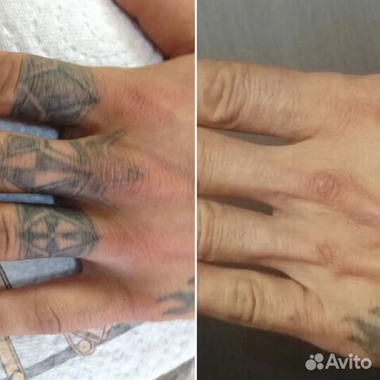 Лазерное удаление татуировок