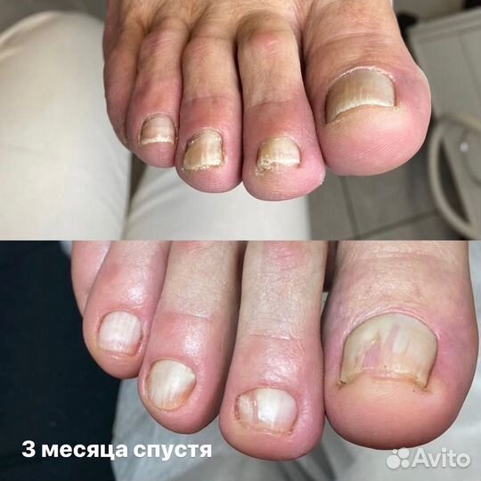 Лечебный педикюр, подолог