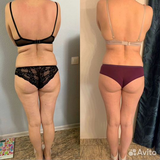 Криолиполиз, похудение