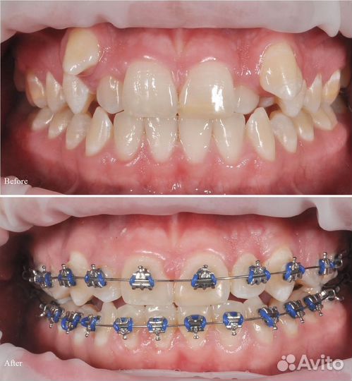 Модель на брекеты