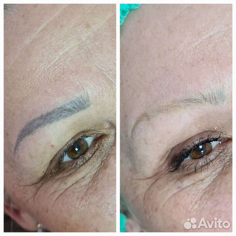 Удаление татуажа лазером