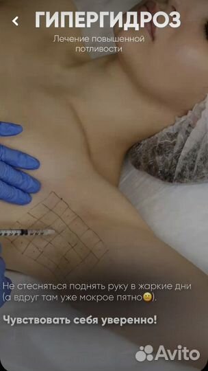 Лечение гипергидроза
