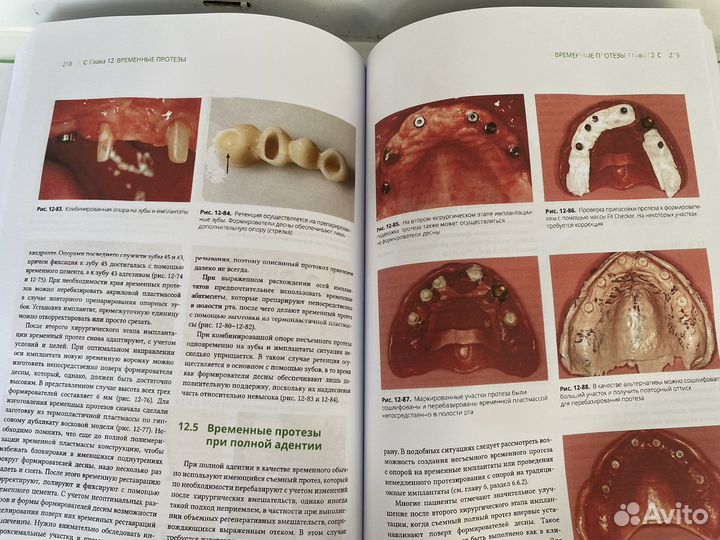 Протезирование с опорой на имплантаты
