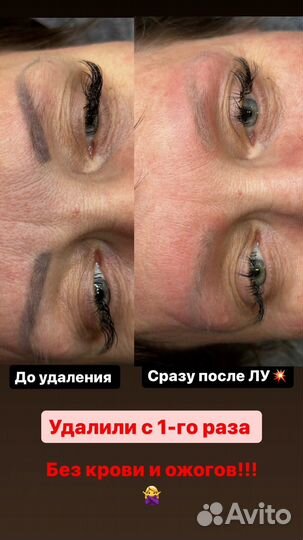 Лазерное удаление татуажа, татуировок