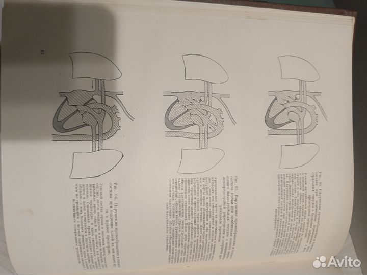 Бакулев А.Н. Врожденные пороки сердца