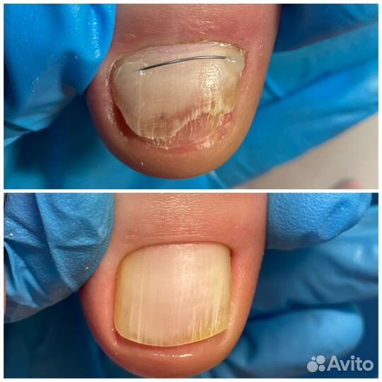 Мед. педикюр. Титановая нить. Подолог