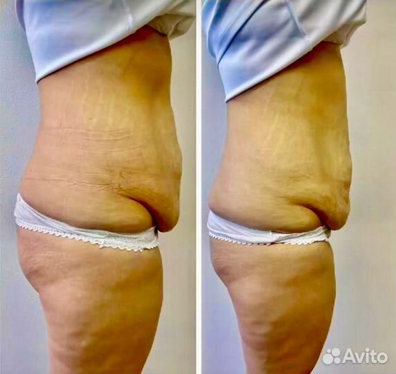 Антицеллюлитный шок аппаратный массаж