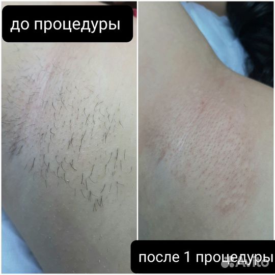 Электроэпиляция