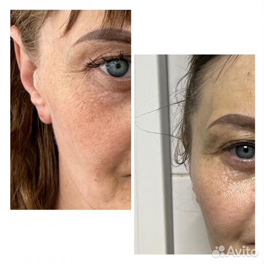 LPG массаж,кавитация,вакуумный массаж,рф лифтинг п