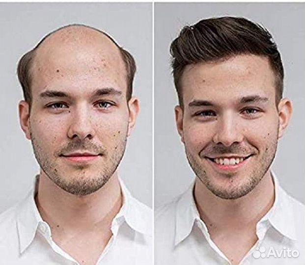 Система волос для мужчин