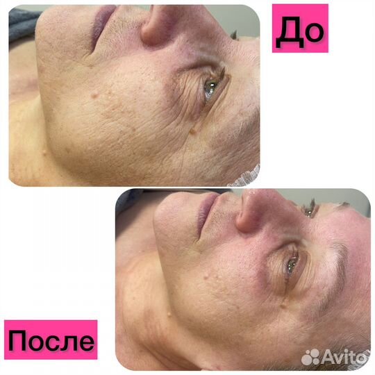 Омоложение лица