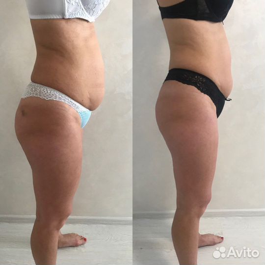 Антицеллюлитный массаж ручной