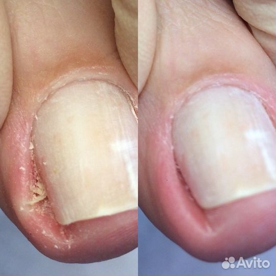 Медицинский аппаратный педикюр