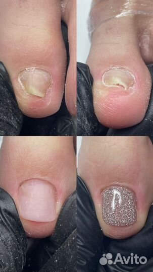 Педикюр подолог