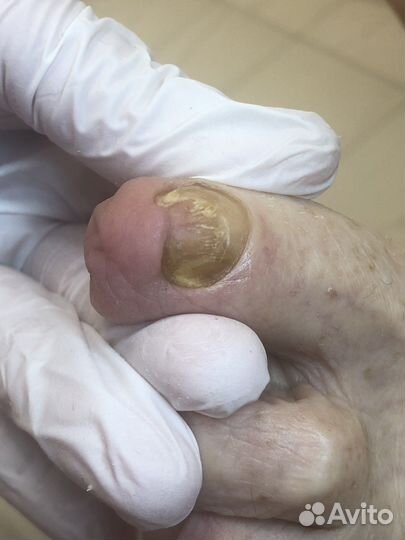 Подолог.Вросший ноготь