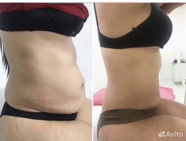 Криолиполиз