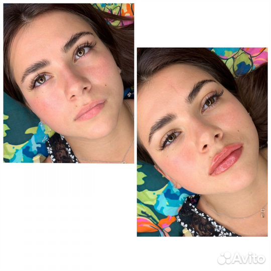 Увеличение губ/кп лица/ботокс обучение