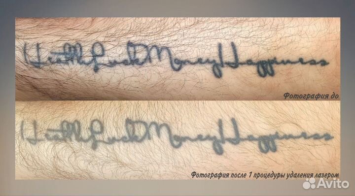 Удаление тату, татуажа, перманентного макияжа