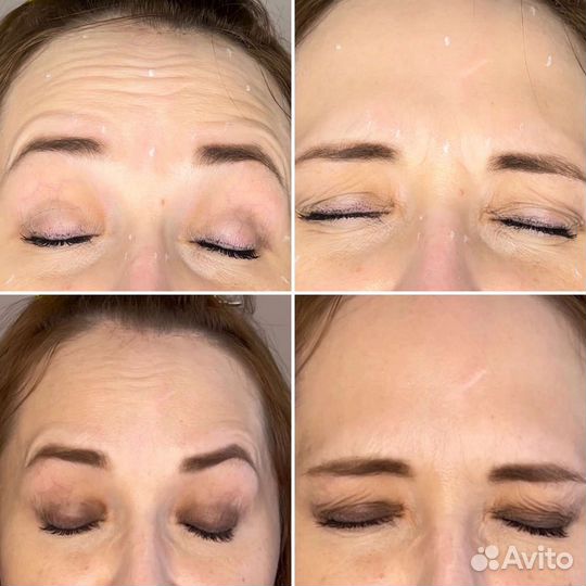 Косметолог плазмолифтинг,ботокс,увеличение губ