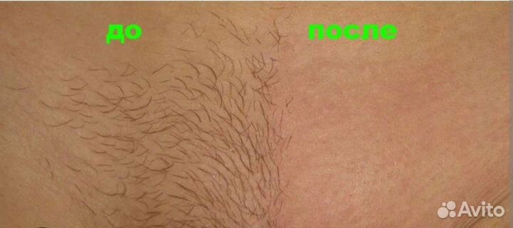 Шугаринг: подмышки